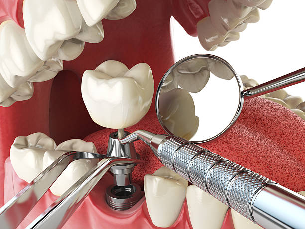 Best Broken or Cracked Tooth Emergency Dentist in Fontana, CA